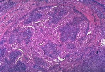 Fallopian Tube from a PID W: Muscular Wall W W M: Inflamed Mucosa L: Lumen with Inflammatory M L M Cells M W