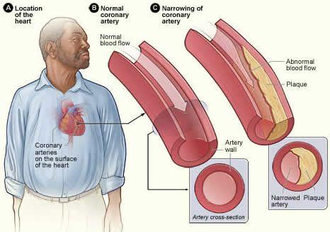 Hardening of the arteries (arteriosclerosis) is caused by a collection of