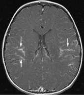 Meningitis Axial contrast-enhanced T1W MR image in a child with acute pyogenic