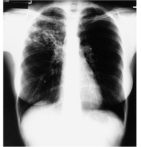 Chest Xray in Pulmonary TB Reasonably sensitive but lacks specificity PPV around 60% & results in