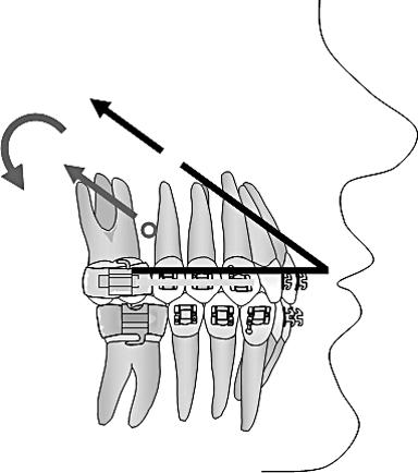 482 VAN STEENBERGEN, BURSTONE, PRAHL-ANDERSEN, AARTMAN FIGURE 2. Force system delivered by a high-pull headgear with a force above the center of resistance of the buccal segment.
