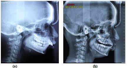 Fig. 7: Extra oral photos Post treatment Fig. 8: Pre (a) and post treatment (b) lateral cephalogram IV.