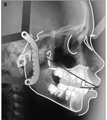 the maxillary splint allows mandibular