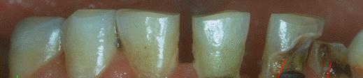 Caries to Cavities 1. Healthy tooth 2. White spot lesion (caries process) 3. Caries process with cavitation 4.
