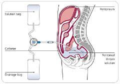 Peritoneal Dialysis Summary CRS is the result of a complex interaction between the heart