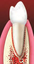 Single Tooth Implant A single tooth implant replaces the missing tooth s roots.