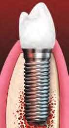 Tooth root Natural Tooth Crown Gum tissue Bone Dental Implant If you are missing one or more teeth,