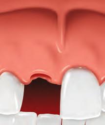 Missing teeth may affect how you speak. A missing back tooth (molar) can make it harder to chew.