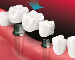 Placing the implant Your dentist will use x-rays or other images to carefully find where the implant should be placed. Then, they surgically place the implant into your jawbone.