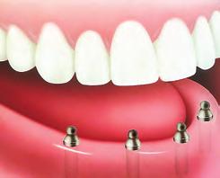 Implant-Supported Denture If you are missing all of your