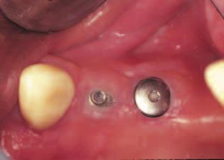 Rotated papilla flap (Figs 21-30) Palacci (1995) has described the rotated papilla flap in the literature for use during second stage surgery in treating submerged dental implants.