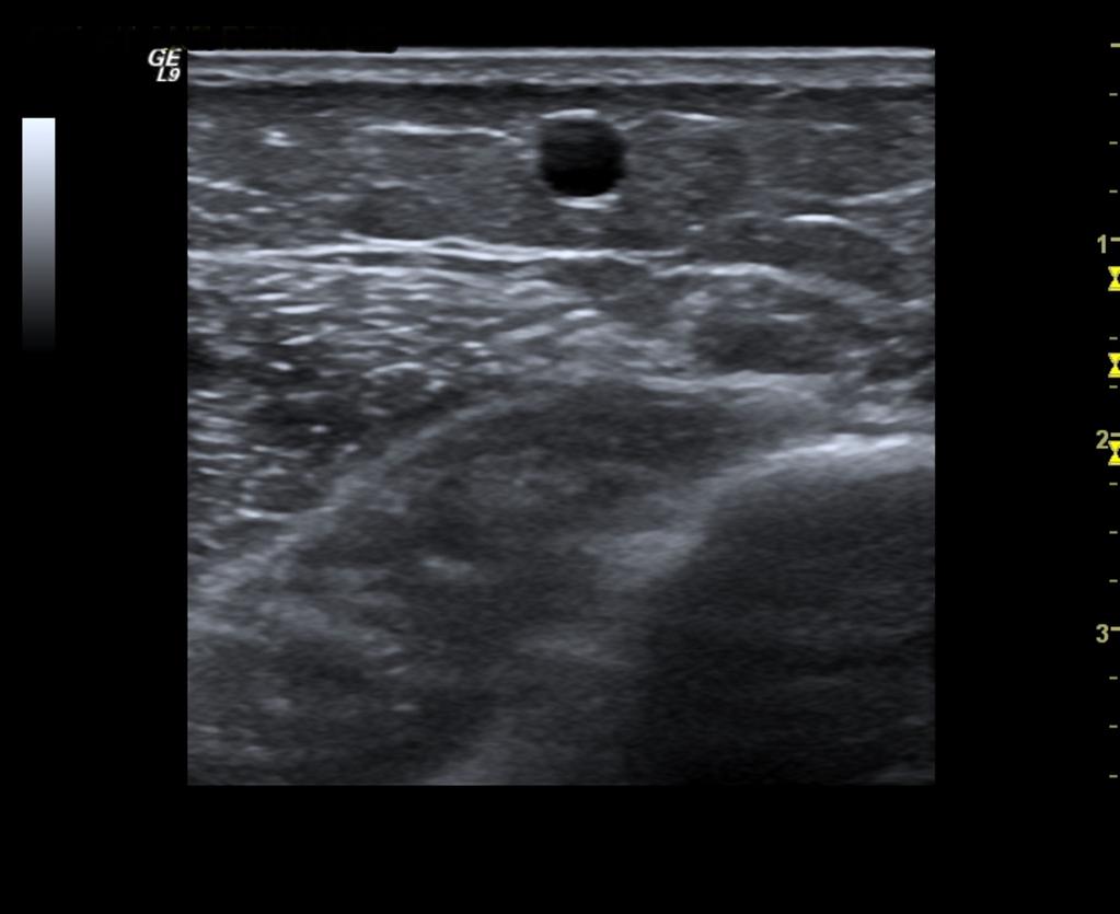 Fig.: 9. Colateral vein surrounded by loose adipose tissue. Great Saphenous Vein (GSV) The terms "long saphenous vein", "greater saphenous vein", and "internal saphenous vein" should not be used.