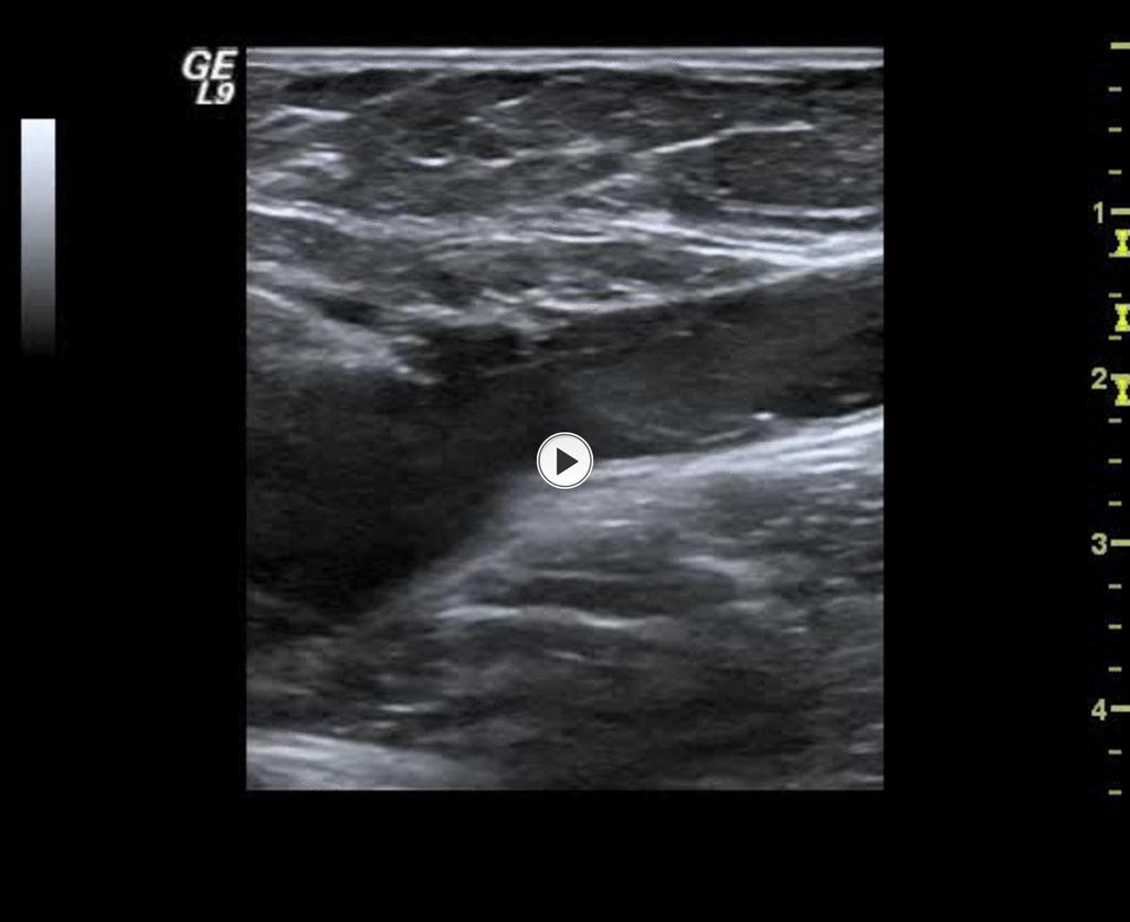Fig.: 10. Great saphenous vein in the thigh and leg Fig.: 11. Sapheno-femoral junction. A pre-terminal valve is clearly seen.