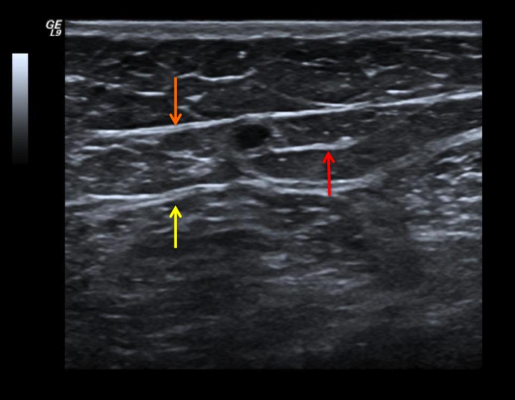 Fig.: 12. Great saphenous vein in its fascial compartment. Orange arrow - saphenous fascia; yellow arrow - muscular fascia; red arrow - collagen strands.
