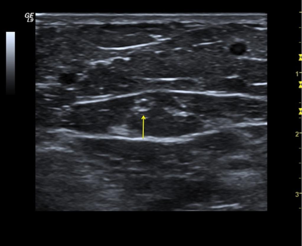 Fig.: 15. Hypoplastic GSV segment (yellow arrow), and two superficial collaterals.
