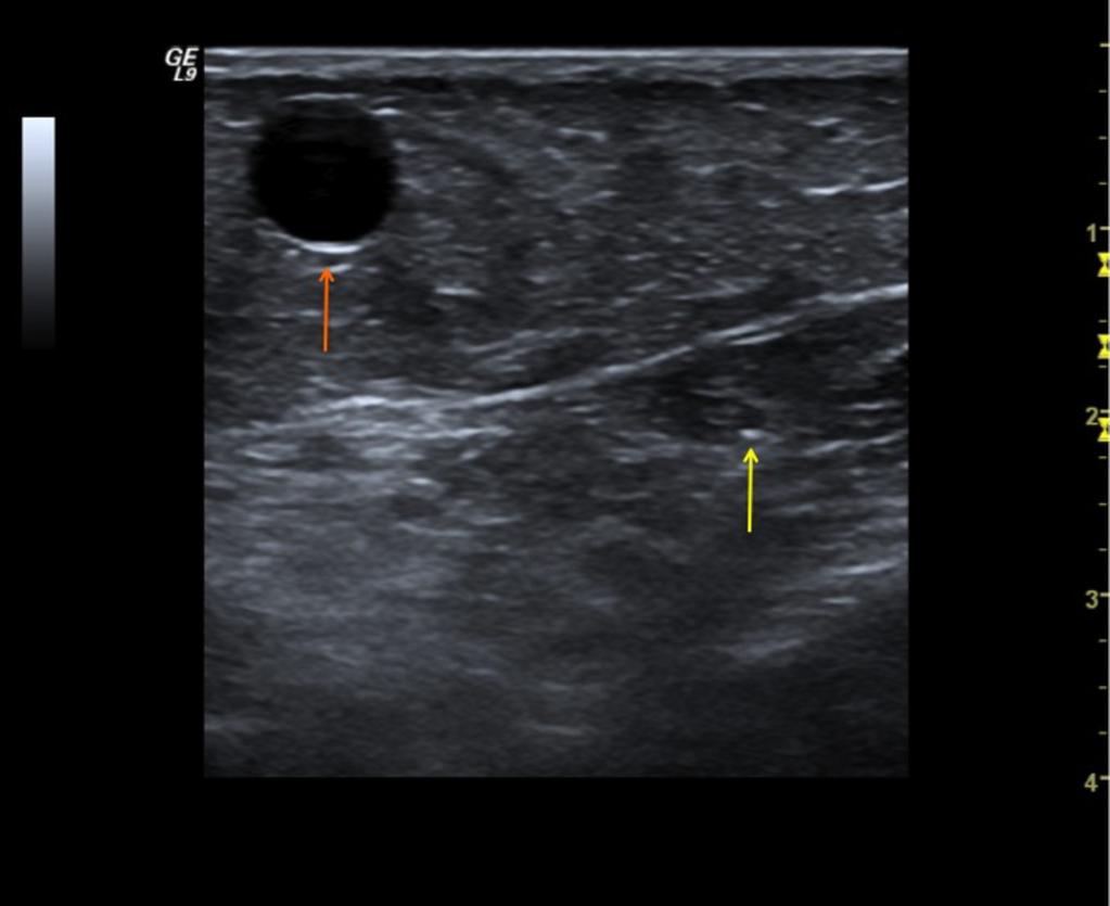 Fig.: 16. Hypoplastic GSV (yellow arrow). Note the presence of an ectatic and incompetent collateral (orange arrow), that bypasses flow (reflux assessment not shown).