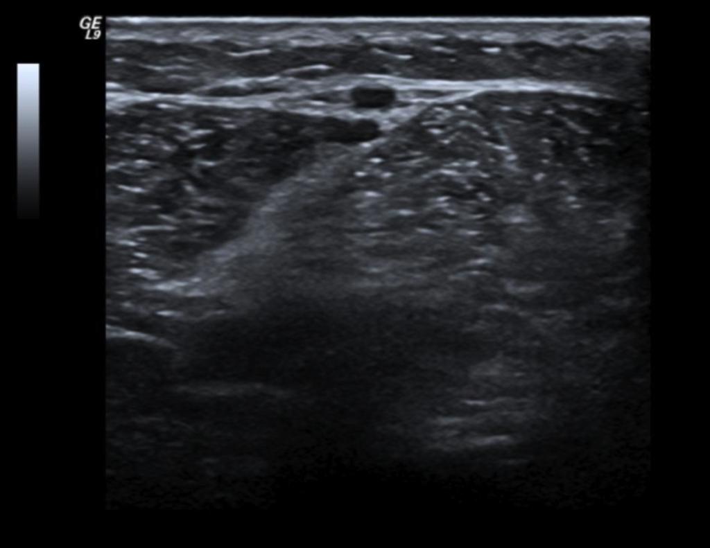 Fig.: 17. Smal saphenous vein in the posterior leg. The SSV lies for its entire length in an interfascial compartment defined by the deep muscular fascia and superficial fascia (fig. 18). Fig.: 18.