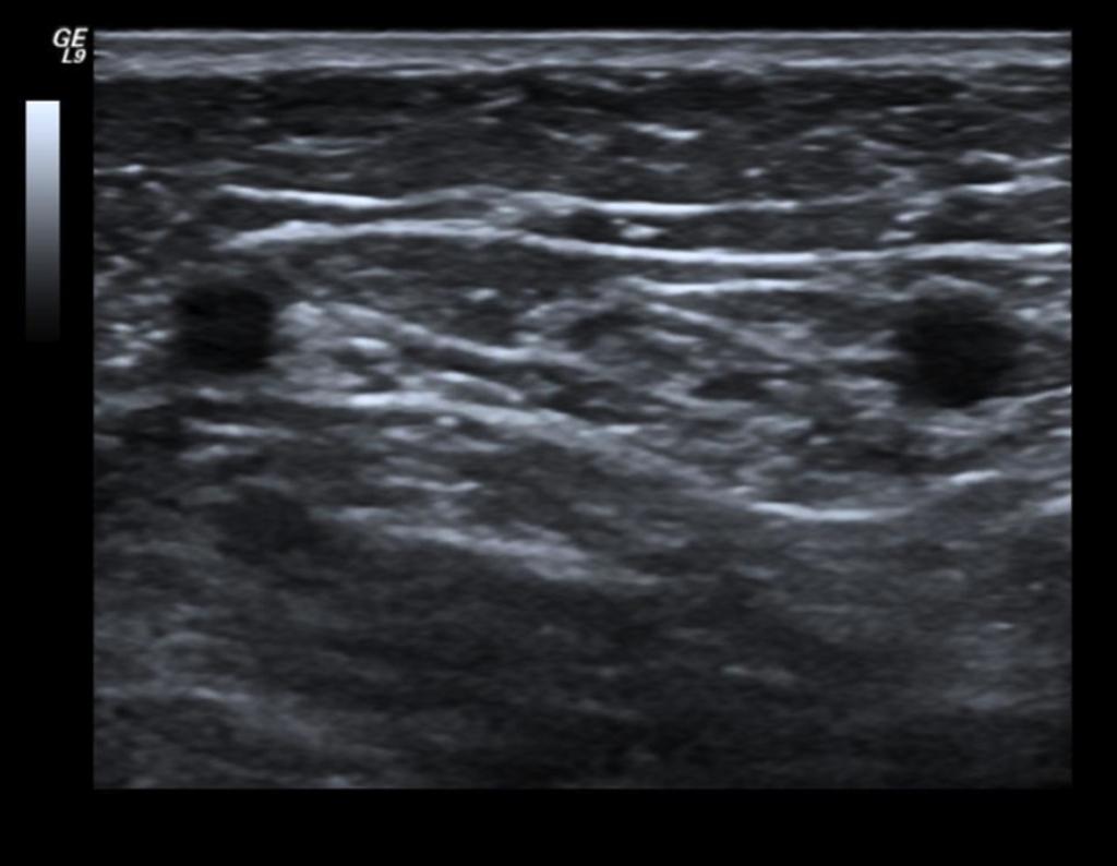 Fig.: 21. Anterior accessory vein Fig.: 22. Transverse plane close to the sapheno-femoral junction, the GSV medially and the AASV laterally lying within the same saphenous compartment.