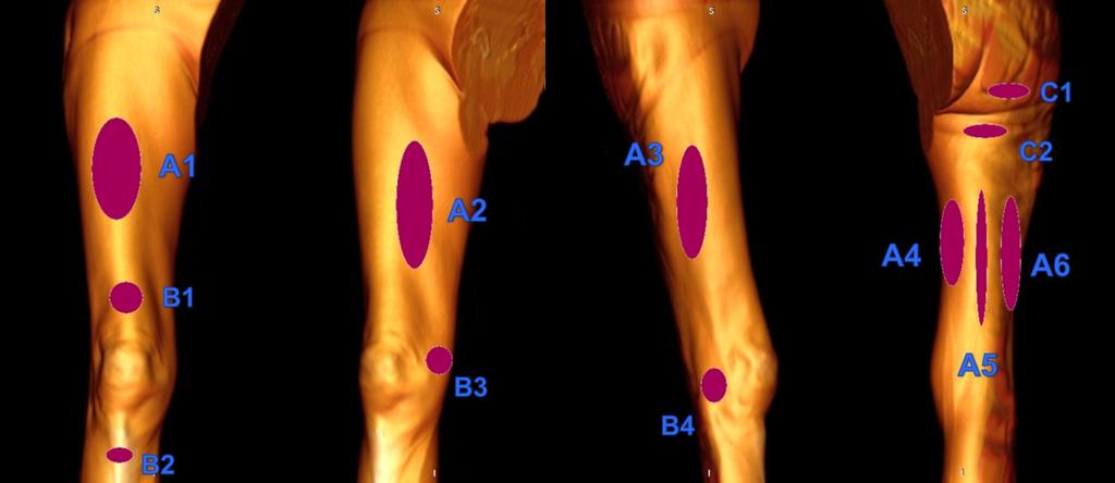 Fig.: 25. Posterior thigh circumflex vein Perforators (PV) The deep and superficial venous systems are joined by the perforating veins.