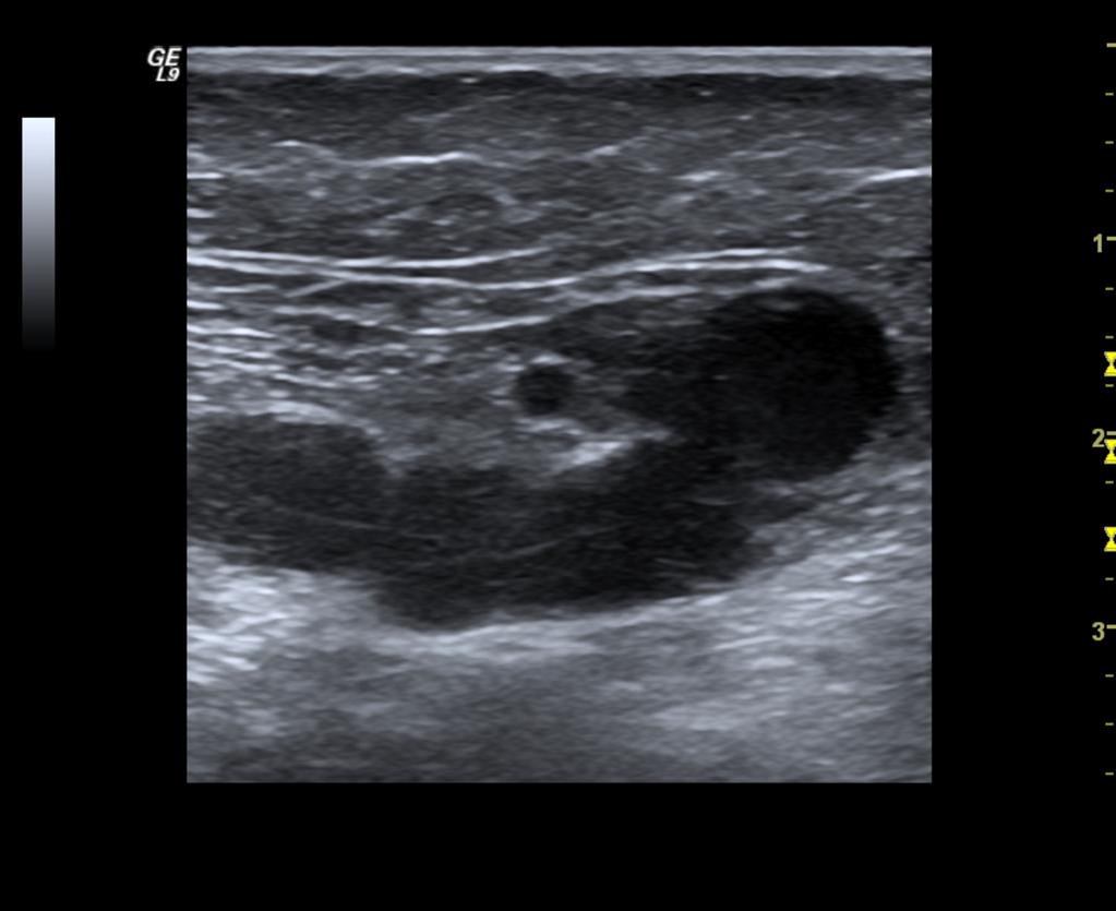 Fig.: 28. Very dilated perforator of the femoral canal. The GSV can be seen in its compartment.
