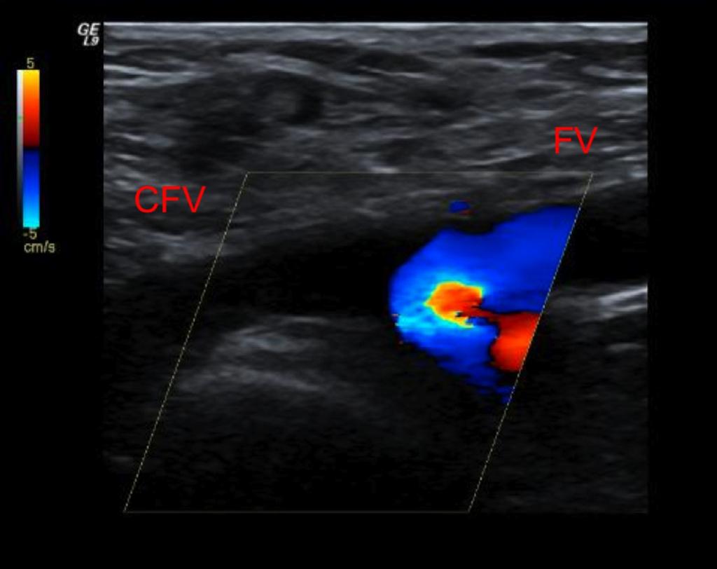 Fig.: 2. Common femoral vein thrombus. A very hypoechoic thrombus is present in the common femoral vein. Blood flow is being diverted to the deep femoral vein.