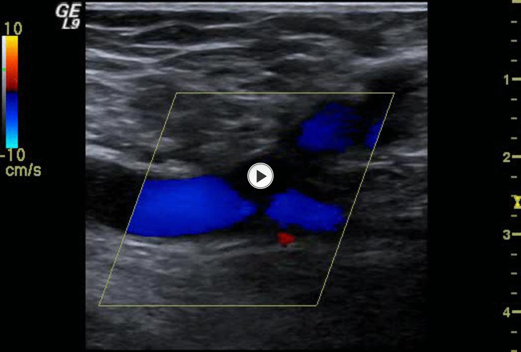 Fig.: 36. A short video clip explains the findings. Retrograde flow is seen due to sapheno-femoral junction terminal valve insufficiency.