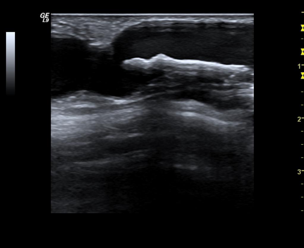 Fig.: 43. Enlarged great saphenous vein with linear high echogenicity material associated with acoustic shadowing. Most likely calcified sequelae from previous thrombophlebitis.