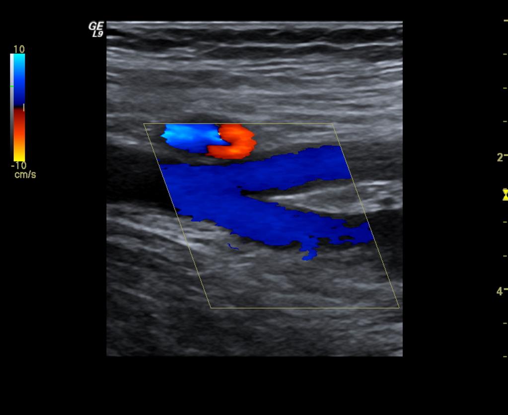 Fig.: 4. A - Duplication of the femoral vein B - Another example of duplication, with an acute thrombus in one of the veins.