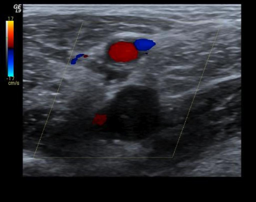 Fig.: 6. Deep femoral vein thrombosis.