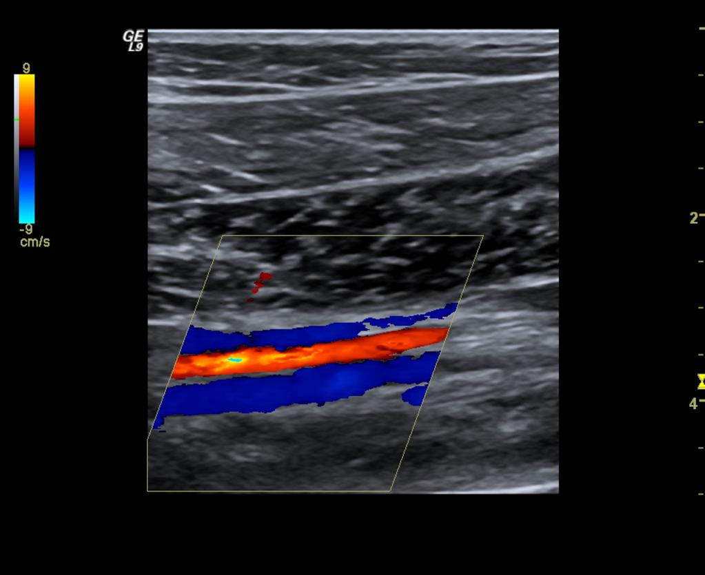 Fig.: 7. Posterior tibial veins. Two veins are seen surrounding the posterior tibial artery. Soleal veins: the veins of the soleus muscle.
