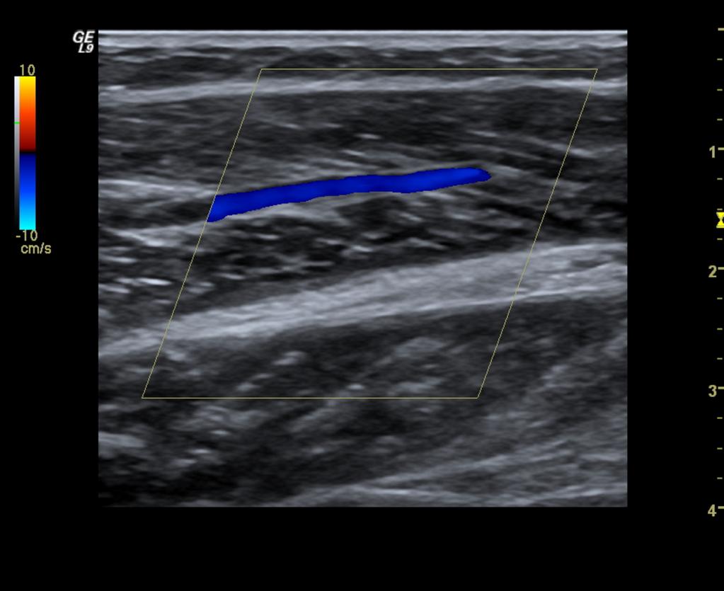 Fig.: 8. Normal gastrocnemius vein in the lower leg. SUPERFICIAL VEINS They are located between the muscular fascia and the dermis, that is, in the subcutaneous tissue.
