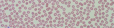 giant platelet syndrome that is