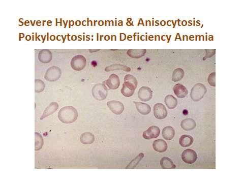 2-Bld Film: microcytic, hypchromic, anisocytosis, poikilocytosis.