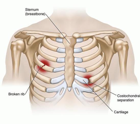 RIB FRACTURE Explanation The heart and lungs are encased by the chest wall, which is composed of the ribs. The ribs must be flexible in order to allow movement during expansion and contraction.