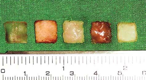 1 2 5 Figure 1. One set of 5 grafts (from left to right): autogenous cartilage, dermis, fat, fascia, and AlloDerm (LifeCell Corp, Branchburg, New Jersey).