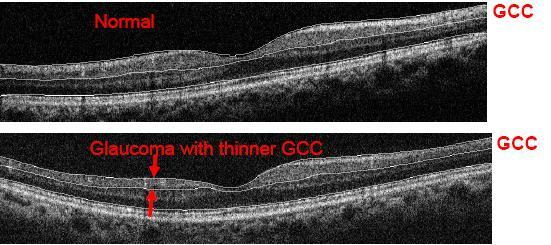 Retinal thickness mapping is not sensitive for