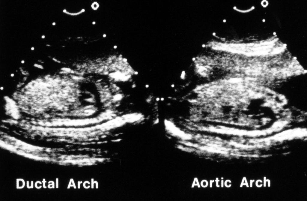 Aortic and