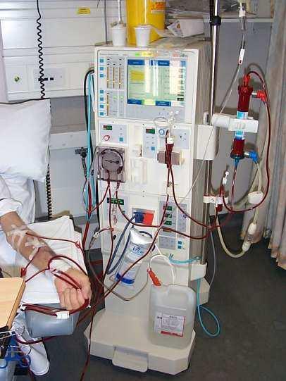 Intermittent Haemodialysis Peritoneal Dialysis CAPD APD Indications for CRRT CVVHD