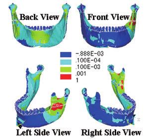 Tensile stress maps of loading by mandibular ramus  8