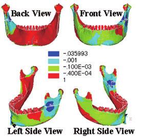 Tensile stress maps of loading by mandibular body