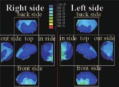 10 Compressive stress maps of loading by mandibular body 