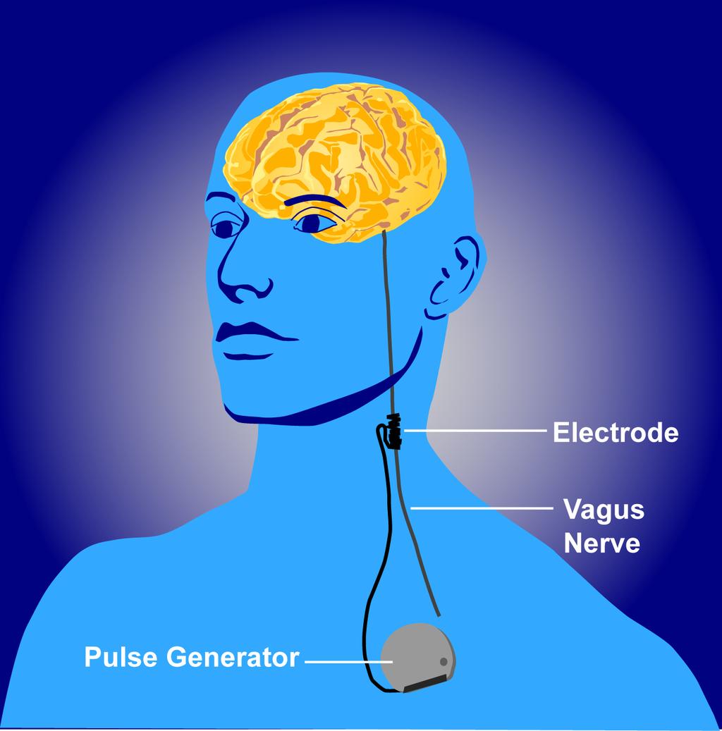 INVASIVE BRAIN STIMULATION VNS 30% Response; 15% Remission over 6-12 months Surgical, hoarseness,