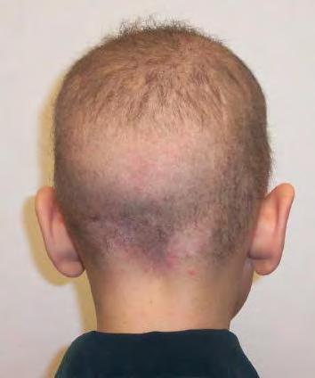 Amish Brittle Hair Syndrome First described in early 1970s The disease related gene identified on 2005: TTDN1 or C7ORF11 on chromosome 7p14 Genetics: autosomal recessive Other