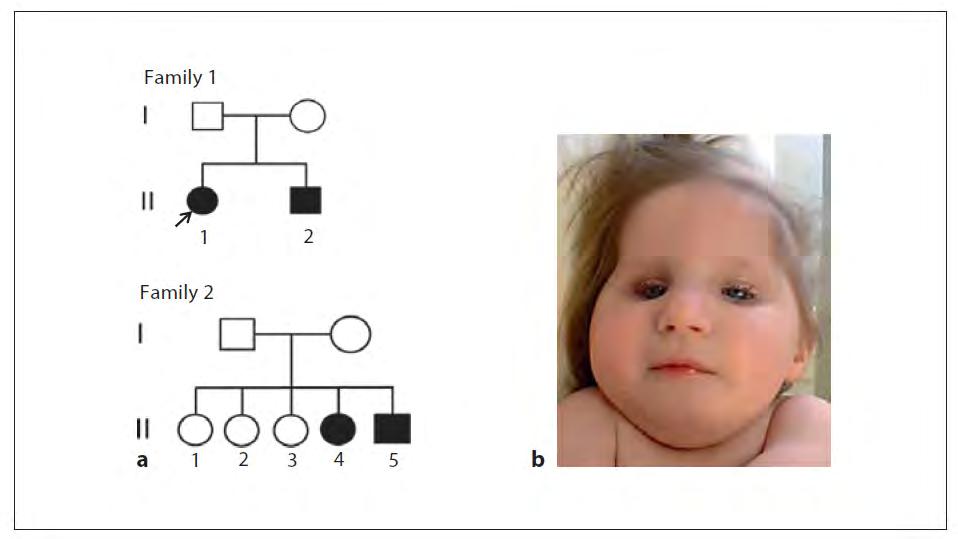 Cockayne Syndrome Genetics: autosomal recessive Related genes: ERCC6 and ERCC8 Severe in Amish, notable at