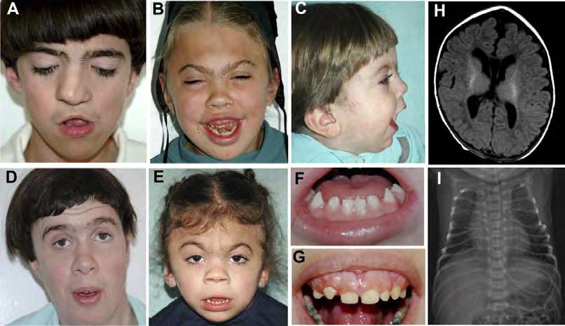TMCO1 Defect Syndrome Autosomal recessive disorder Characterized by