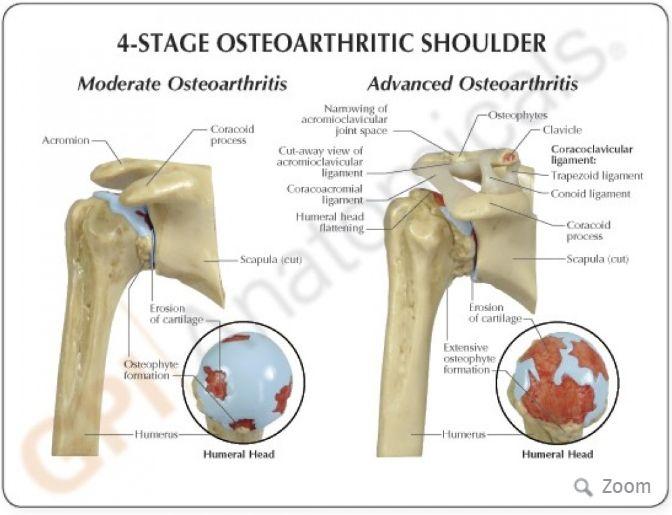Osteoarthritis Most common type of arthritis in the shoulder Causes: Progressive wear & tear of cartilage