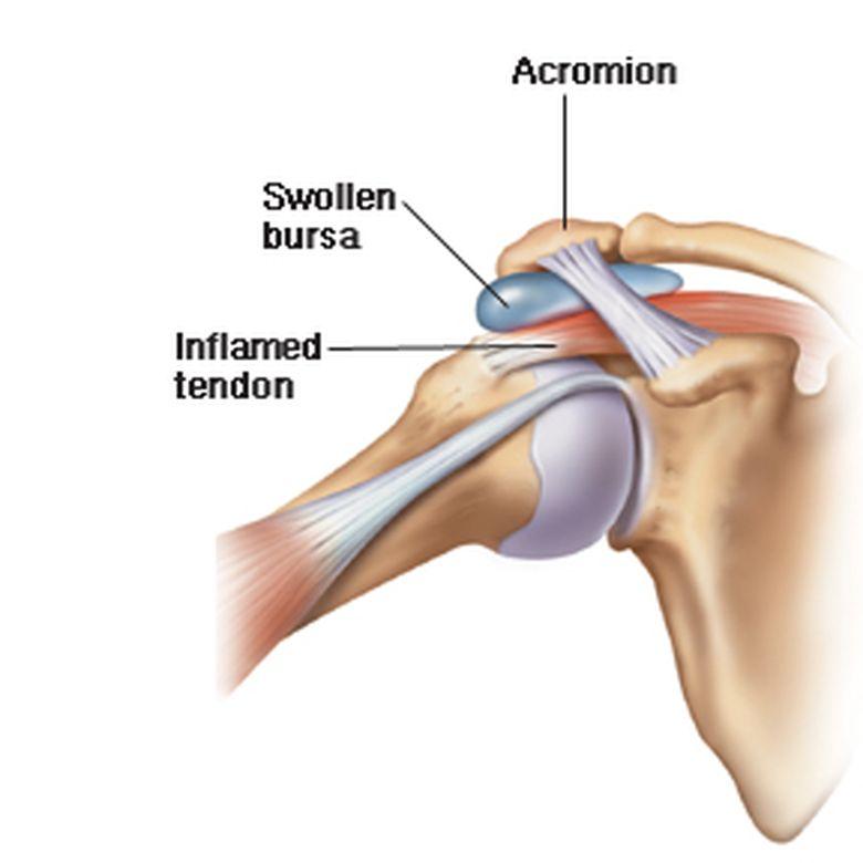 Subacromial Bursitis Swollen bursa between rotator cuff tendons and acromion Causes: Repetitive minor