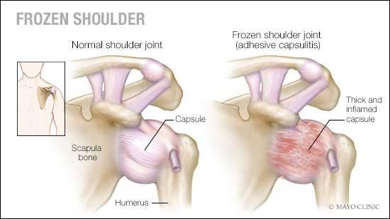 Frozen Shoulder Also called Bones, ligaments, and tendons of shoulder are encapsulated by scar/connective tissue.