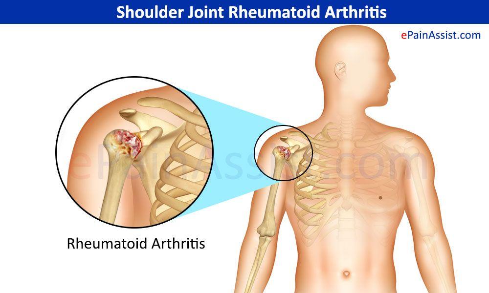 Autoimmune Diseases Rheumatoid Arthritis Body attacks tissue synovium