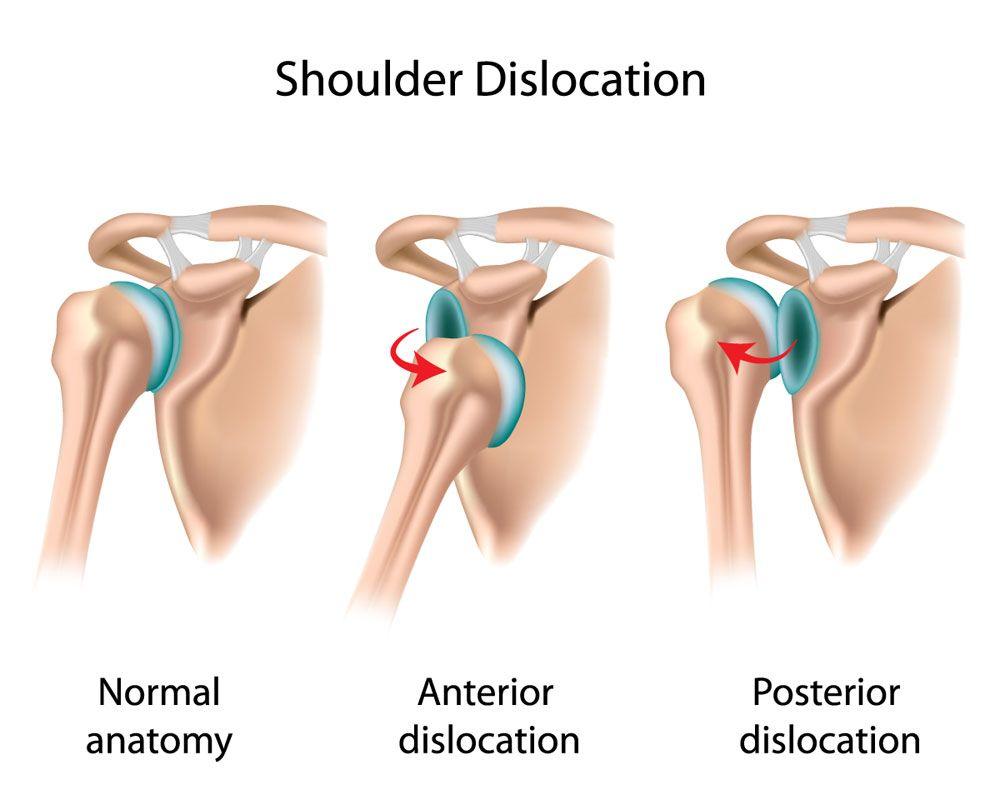 Dislocation Most commonly dislocated joint After dislocation(s) more susceptible